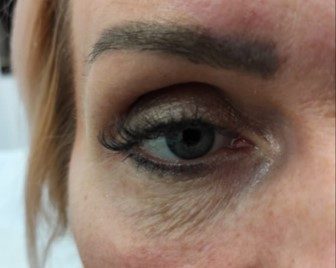 Huid rond het oog voor de exosomenbehandeling
