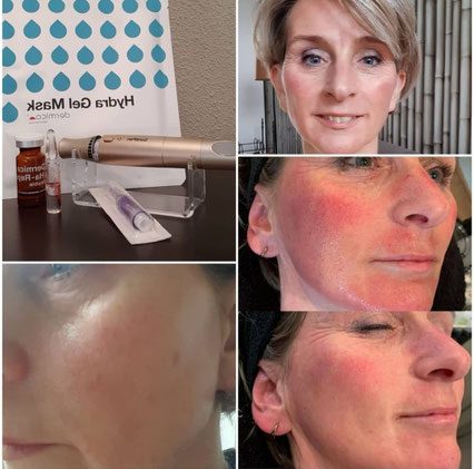 Microneedling met de Goldpen en het resultaat op de huid